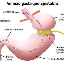 Anneau gastrique virtuel